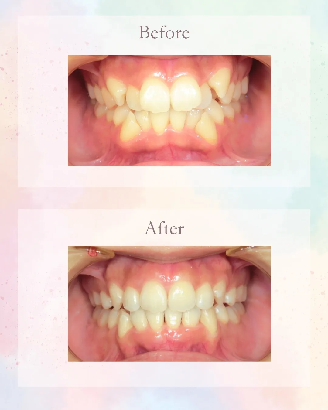 こんにちは!神戸元町 玉川歯科医院です🙂