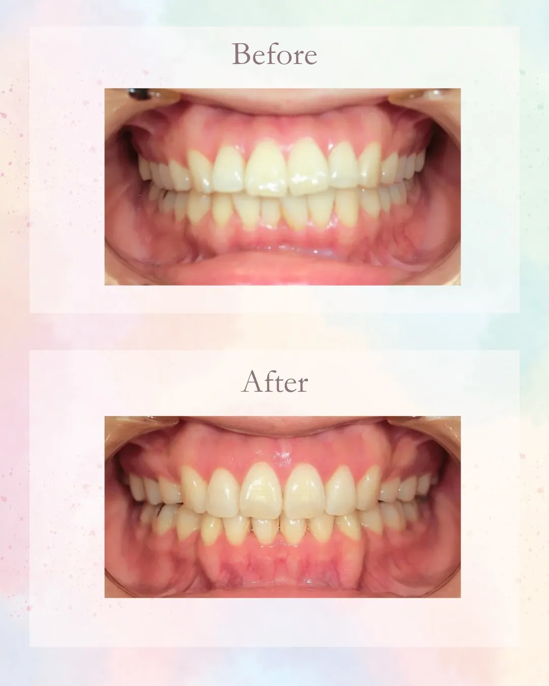 今日は前歯が出てるのを治した症例!こんにちは!神戸元町 玉川...