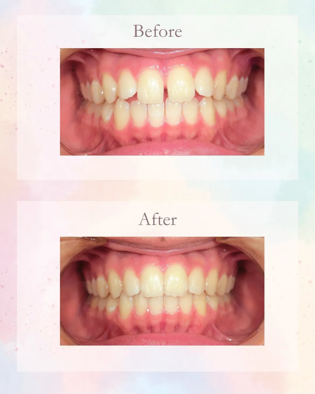 今日はすきっ歯の症例をご紹介!こんにちは!神戸元町 玉川歯科...