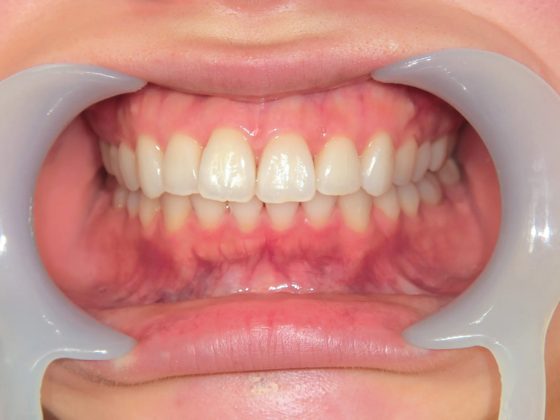 芸能人は歯が命とかなんとか。